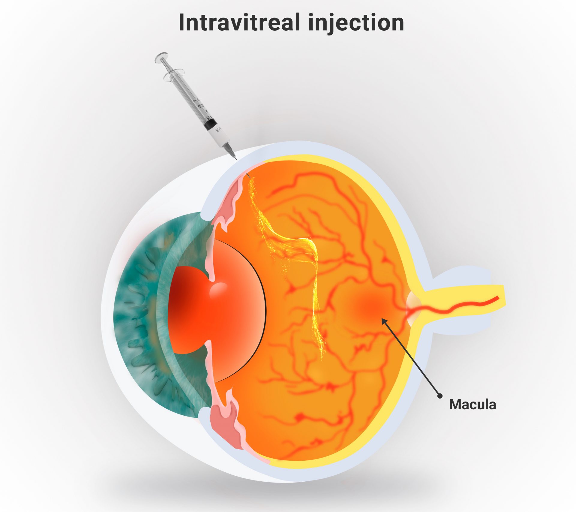 Intravitreal Injection Procedure for Macular Degeneration
